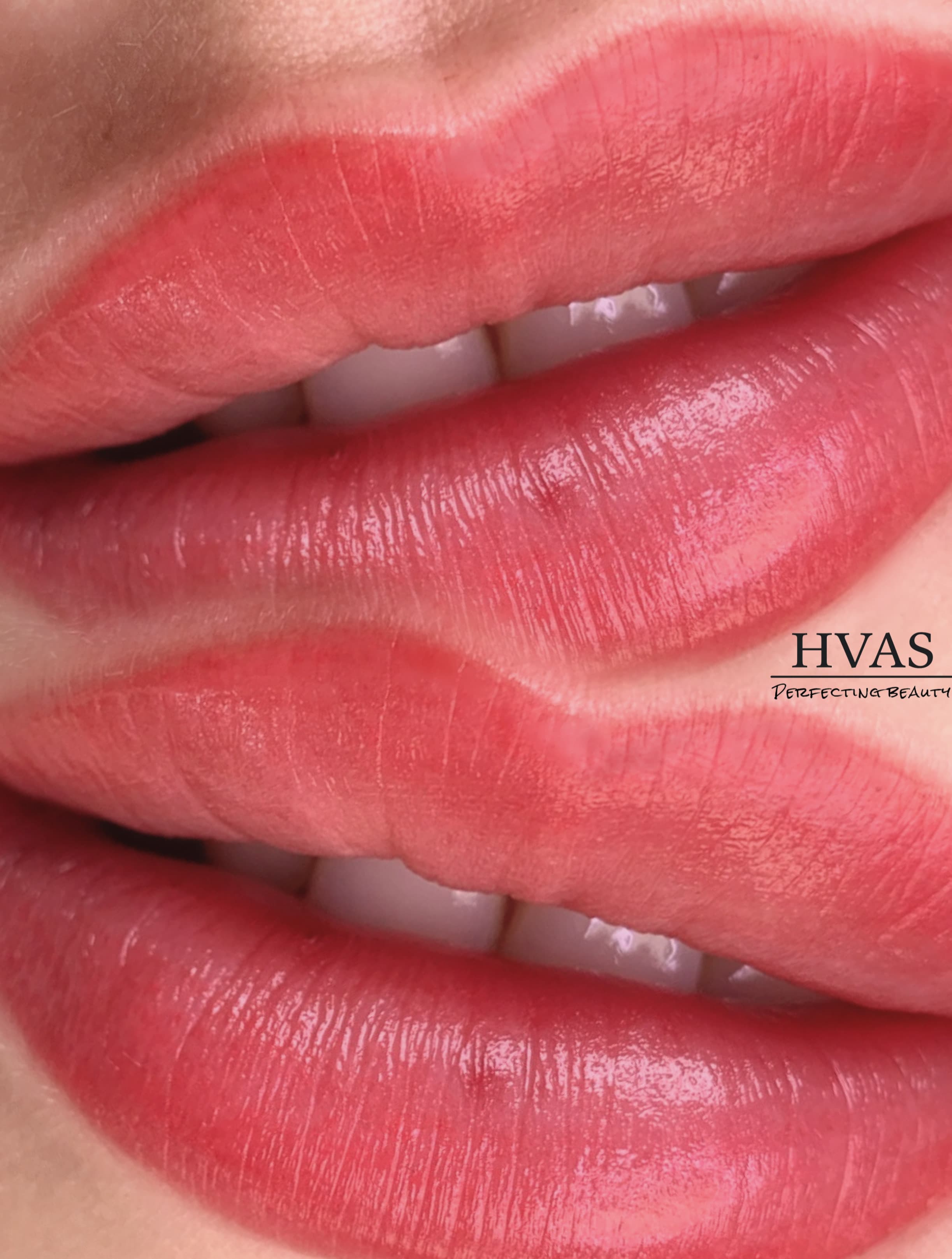 Permanente læber før og efter resultat 4