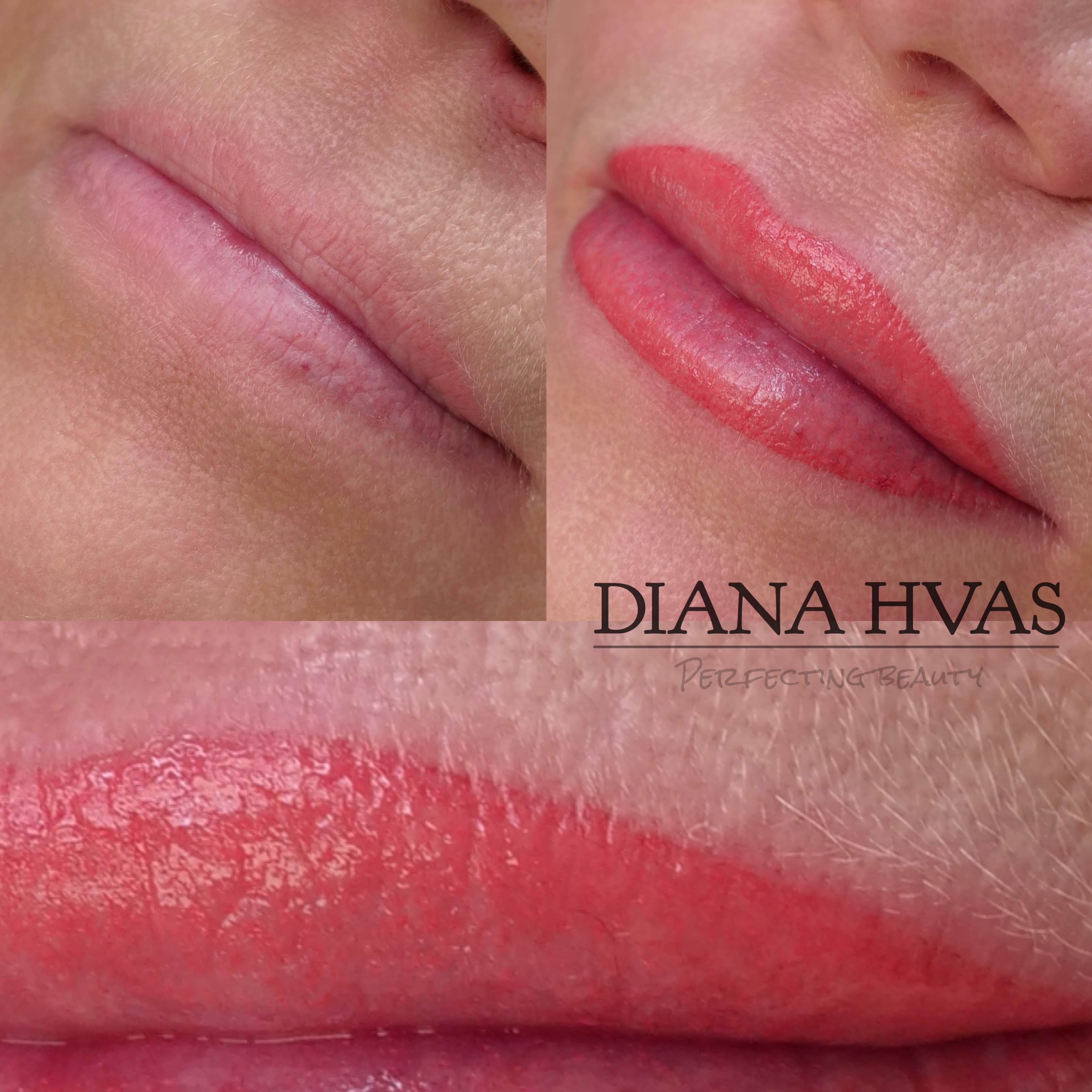 Permanente læber før og efter resultat 6