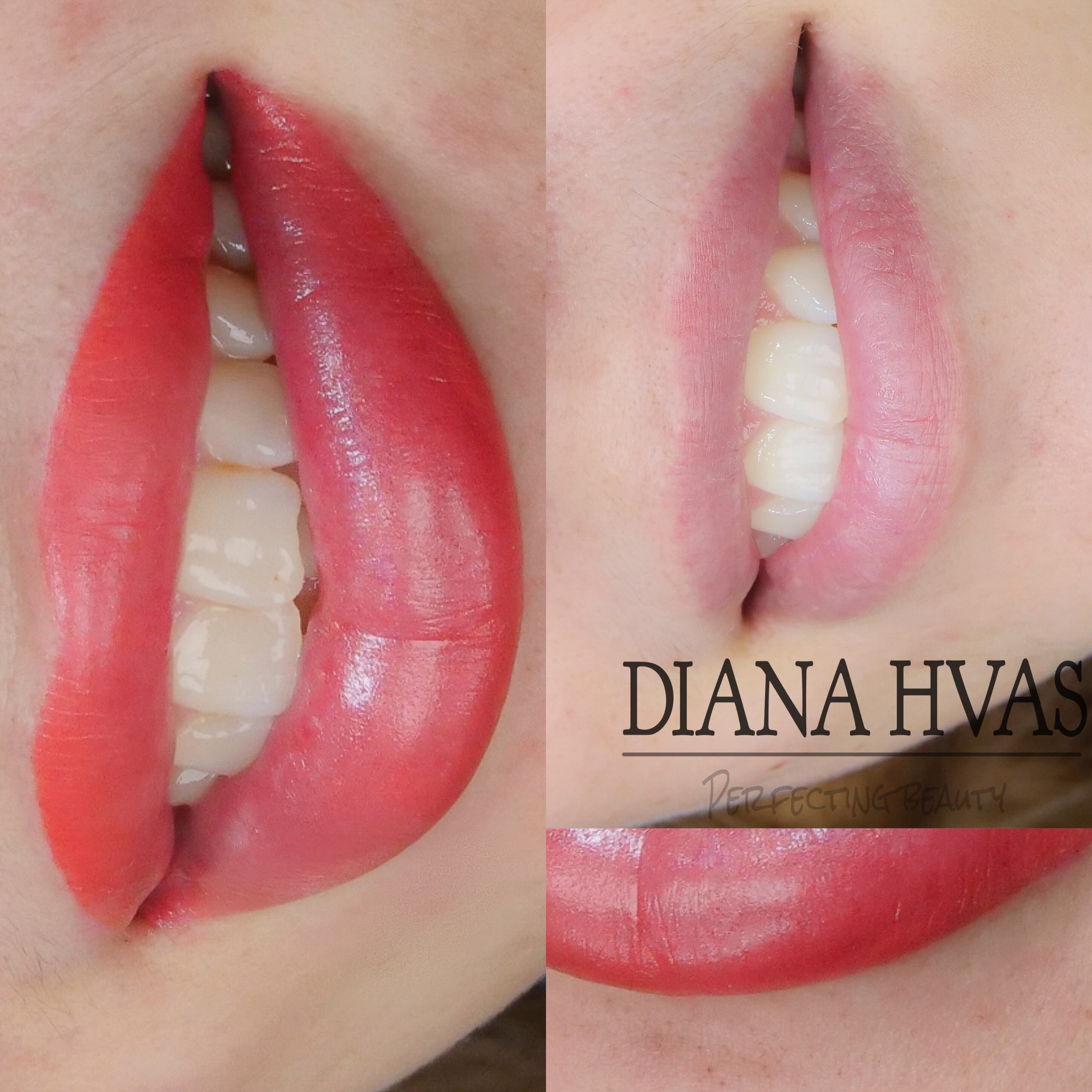 Permanente læber før og efter resultat 7